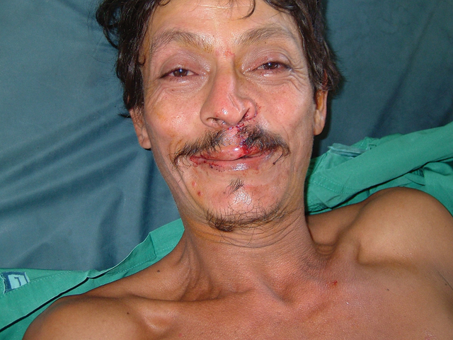 During a 2006 mission to Nicaragua, ISMS' New York team repaired the cleft lip of a 42-year-old man. This photo, Dr. Patel said, marks the first time he ever smiled. (Courtesy photo)