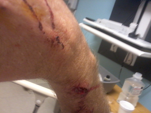 COURTESY | Injuries Gregory Madr sustained to his right leg after an unknown dog attacked him in the front yard of his Flanders Road home.